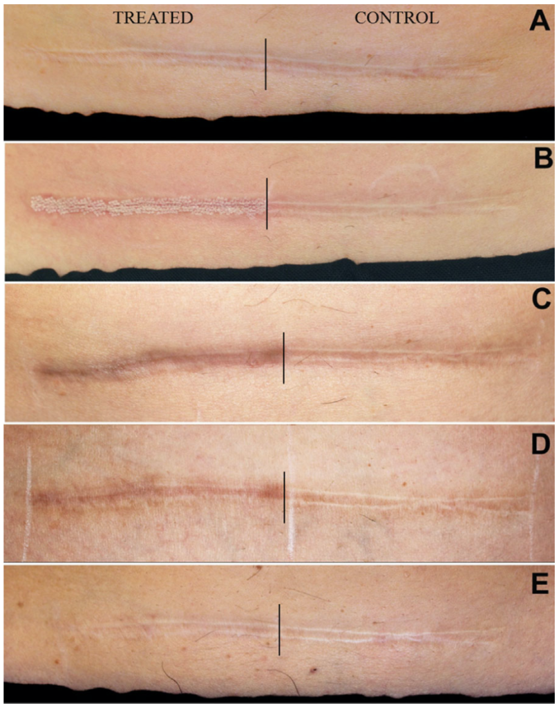 剖腹產疤痕以UP雷射治療前後圖片比較 (UltraPulse)